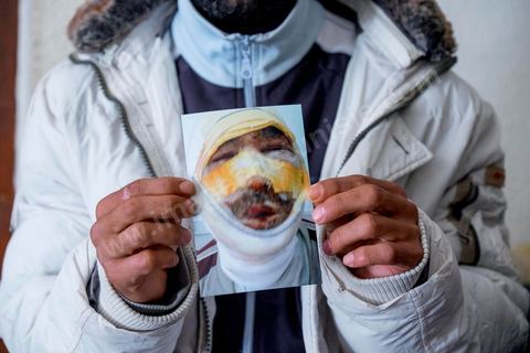 29 janvier 2016 : Baligh Aloui, 33 ans, s'est immolé le jeudi 21 janvier devant sa maison familiale où il vit avec ses parents, frères et soeurs. C'est son frère, Abdelsattar, qui l'a sauvé en se jetant sur lui. A lhopital de Kasserine depuis une semaine son état de santé est stable mais il est brulé au visage et mains au second degrès. Il s'est immolé ce jeudi 21 janvier, au lendemain de l'annonce de la création de 5000 emplois à Kasserine par le gouvernement. Ce jour là, les chômeurs se sont précipités au gouvernorat, aux délégations et aux municipalités pour s'inscrire dans un nouvel espoir d'avoir enfin un travail, une activité stable, un revenu digne, ... cet afflux a créé un désordre, un débordement, des tensions, ... ce jeune se voyant une nouvelle fois rejeté par l'administration, par l'état, est rentré chez lui avec une bouteille d'essence et s'est immolé dans la rue devant sa maison, devant sa mère, ses frères et soeurs. C'est à son frère qu'il doit sa survie, il a pu très vite l'éteindre, mais ce jeune est marqué à vie, brulé au second degrés sur l'ensemble du visage dans l'indifférence totale de la société et du gouvernement, en 2015 113 personnes se sont immolés en Tunisie.